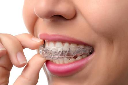 Clear aligner orthodontic treatment